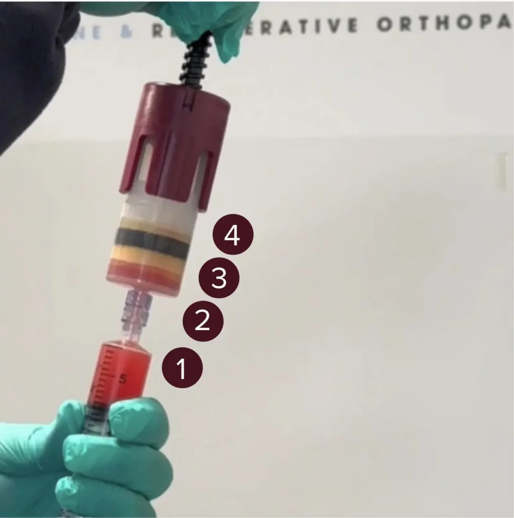 Four adipose fraction layers separated in the Lipo-Pro disposable