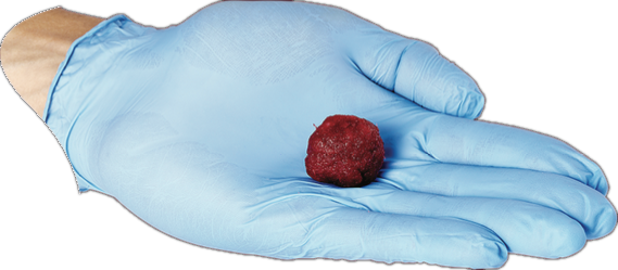 VelvetDBF rehydrated into a moldable, cell-hydrated graft, held in a gloved hand